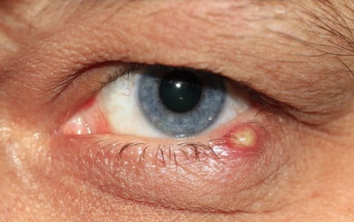 Homme avec un symptôme des infections oculaires