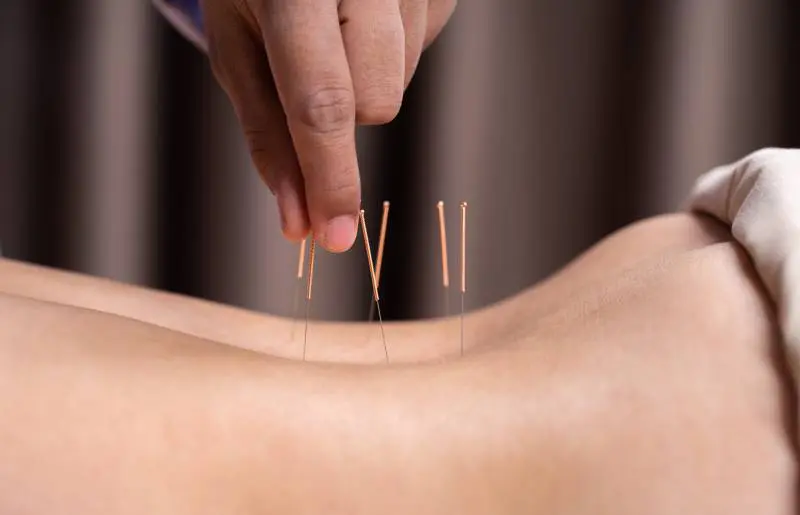 L'acupuncture pour apaiser les douleurs menstruelles 